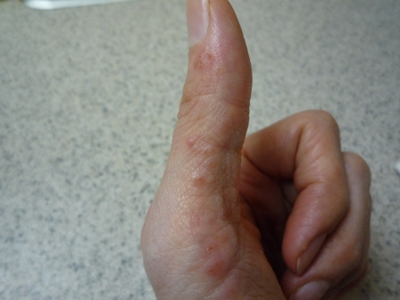 手の湿疹 異常な手のかゆみ・手湿疹の原因は内臓デトックスかもしれないと思い実践して分かったおすすめ痒み緩和法。塗り薬だだと良くならない時に私が試した3つの対策。